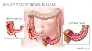 Corneal Manifestations of Inflammatory Bowel Disease